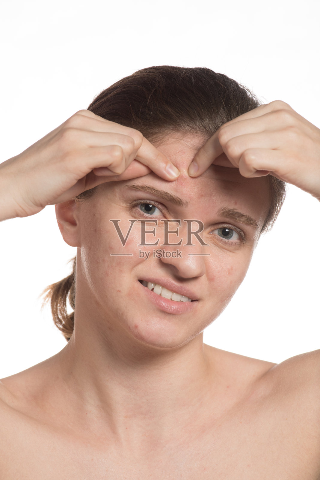 一个脸上长着红白痘痘的漂亮女孩。前后用海绵涂抹。在白色背景上停止痤疮。照片摄影图片