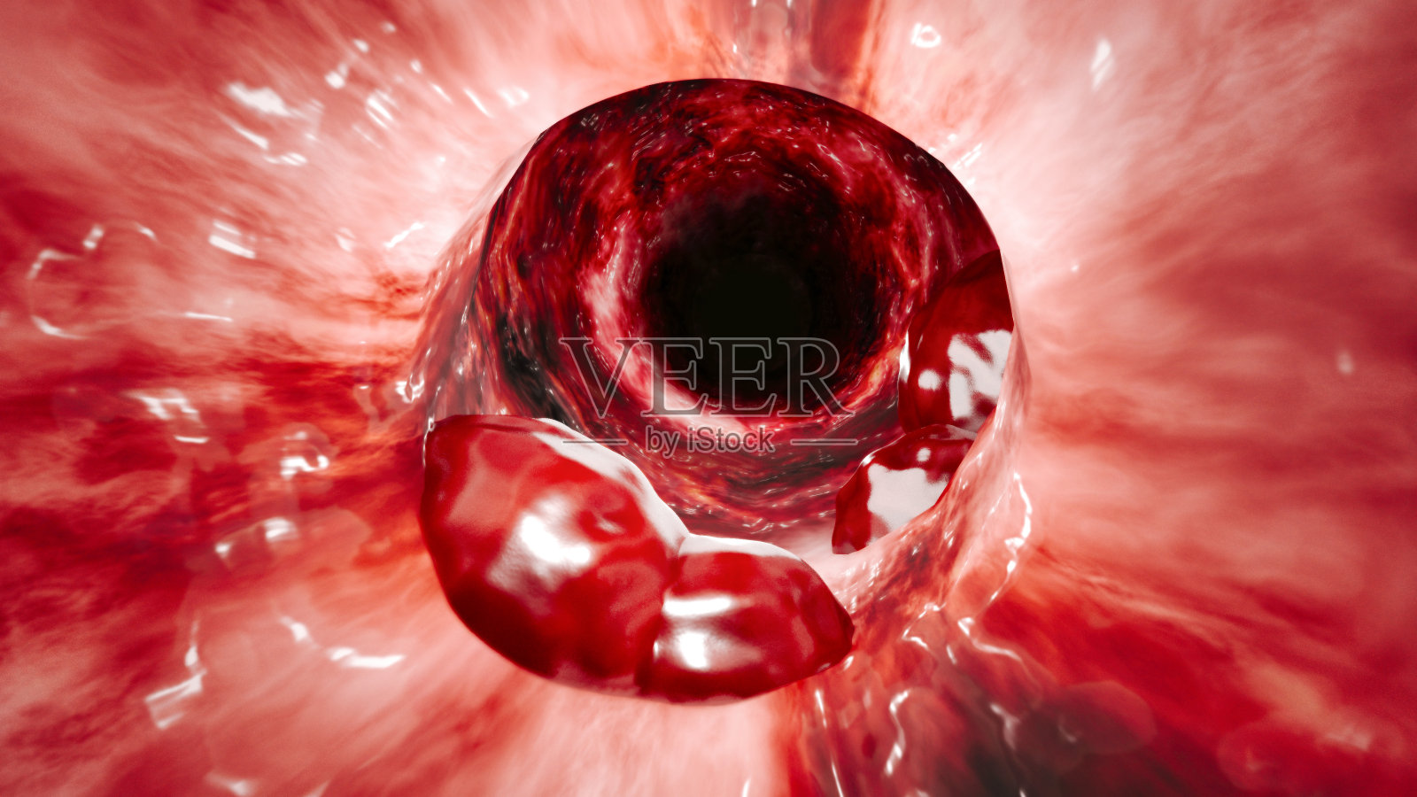 肠壁内部视图。结直肠癌,大肠癌,结肠癌或直肠癌照片摄影图片