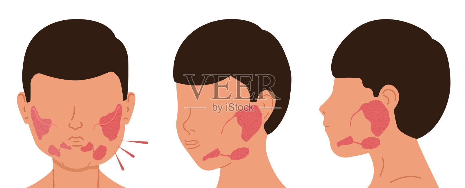 唾液腺有病和健康的人。涎石病的载体说明。插画图片素材