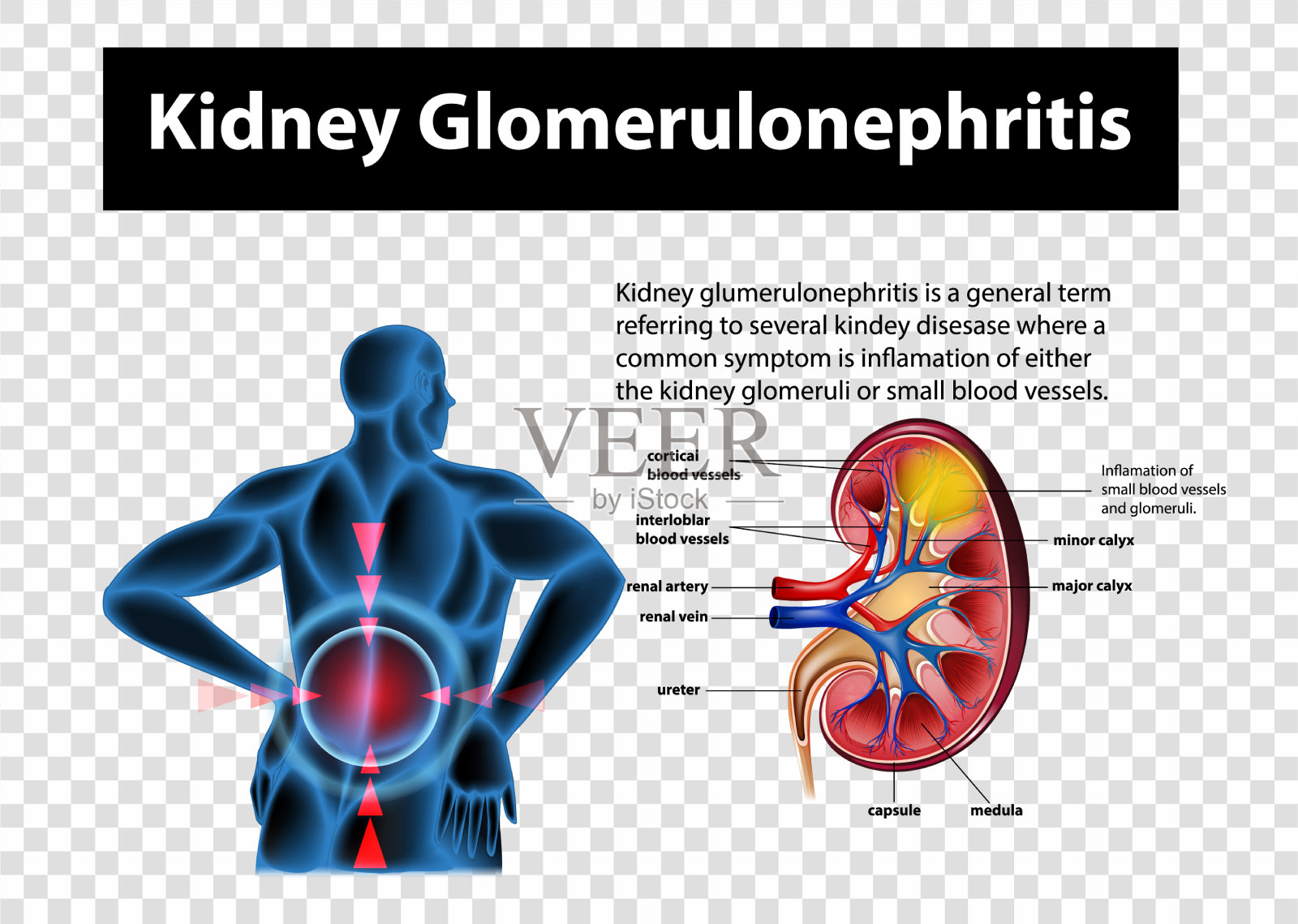 图示肾小球肾炎插画图片素材