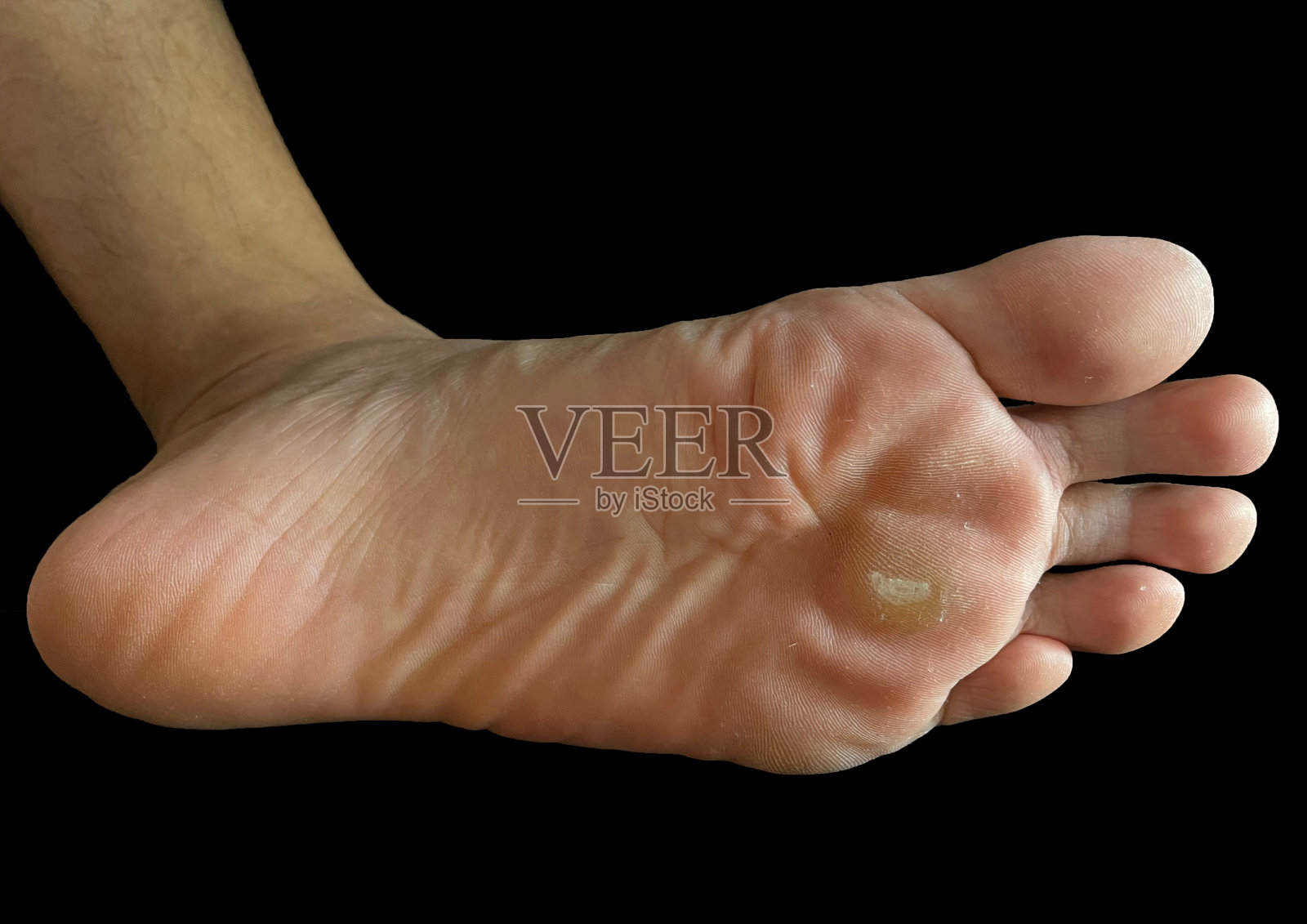 足部皮肤疾病,足部疣,跖骨疣和足底疣照片摄影图片