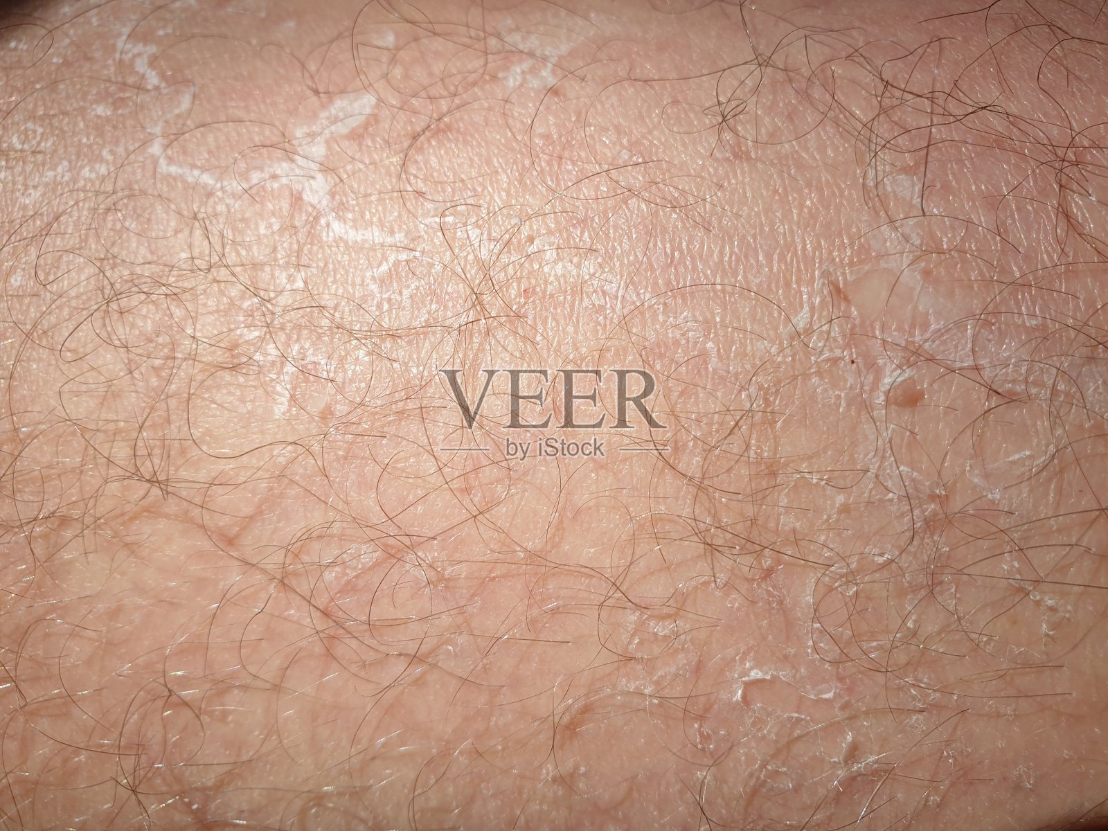 皮肤病。皮肤疾病的特写。照片摄影图片