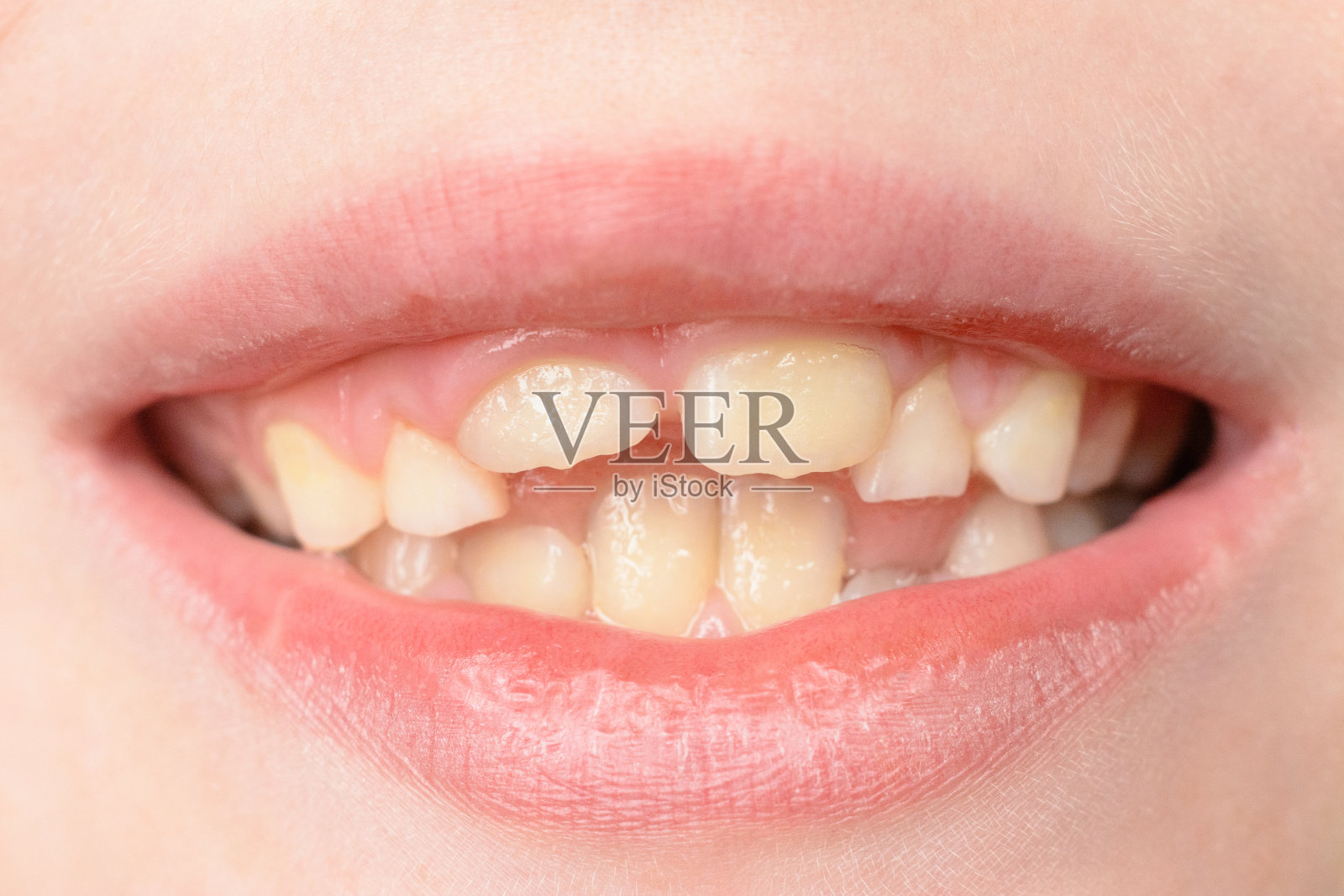 一个小男孩带着弯曲的牙齿微笑的特写镜头照片摄影图片