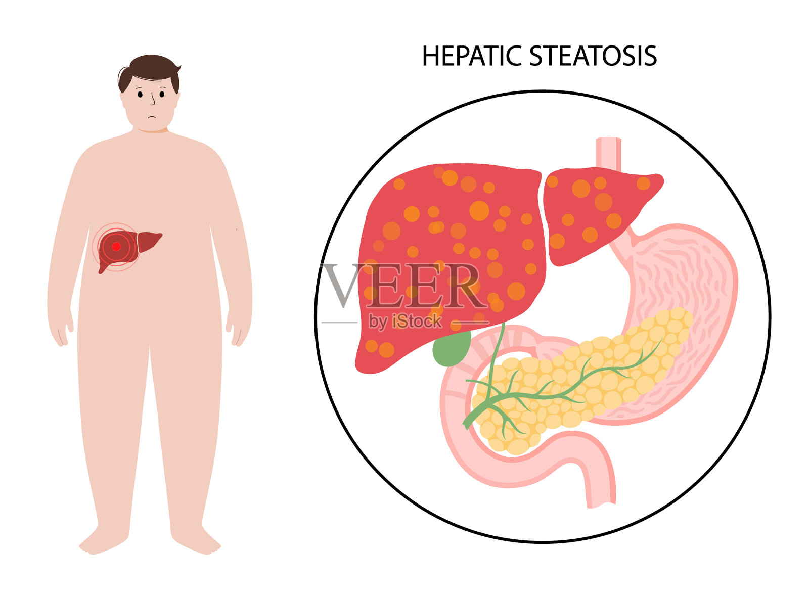肝脏疾病的概念插画图片素材