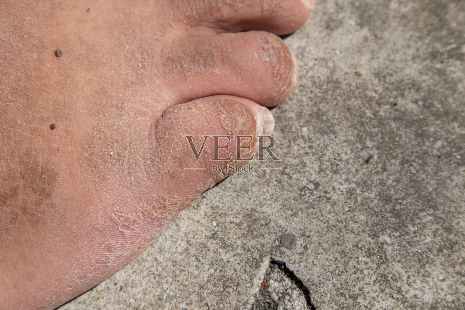 接近干燥和死脚皮肤的脚脱皮照片摄影图片