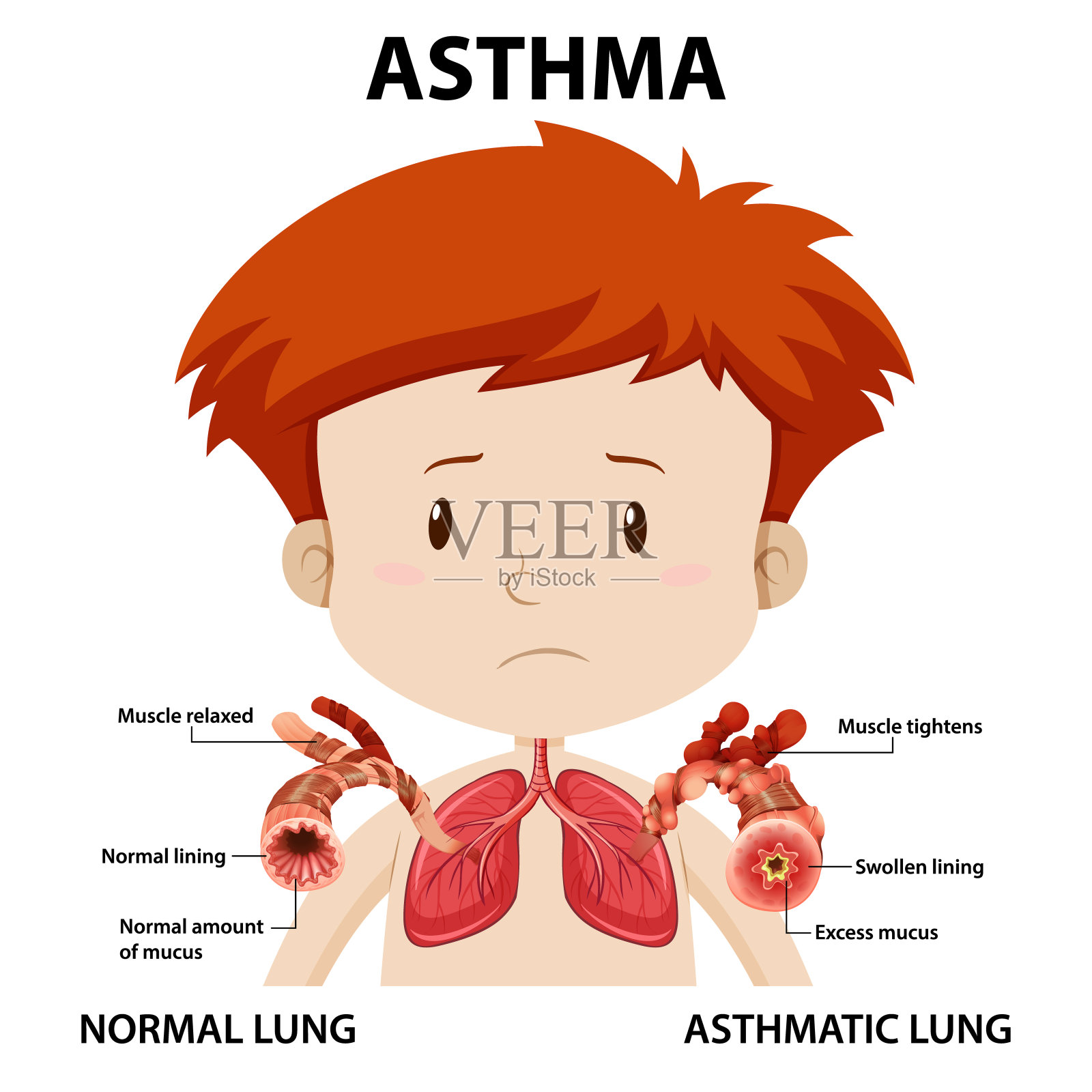 正常肺和哮喘肺的哮喘图插画图片素材