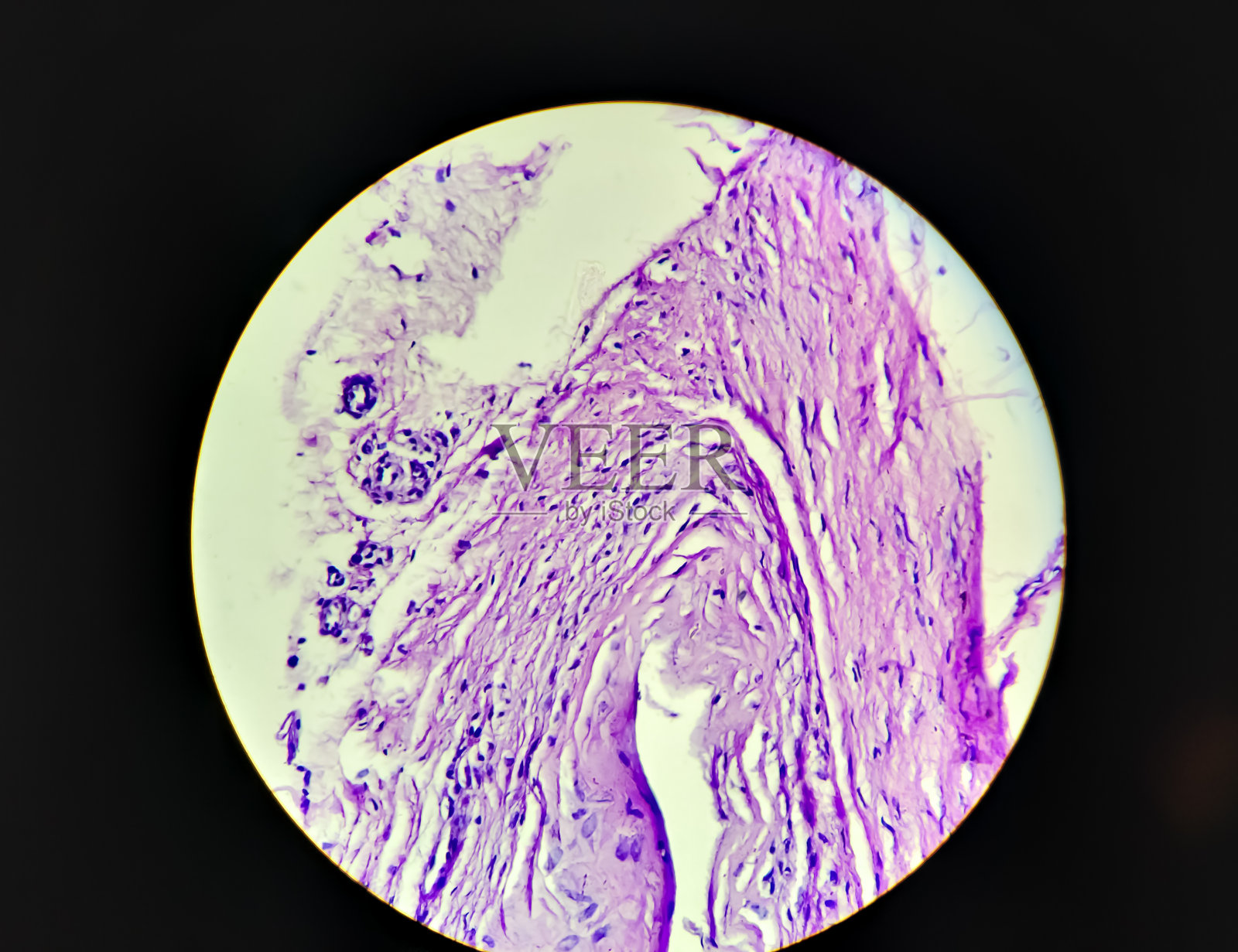 右踝关节囊性肿胀组织(切除0镜下100x显示神经节。照片摄影图片