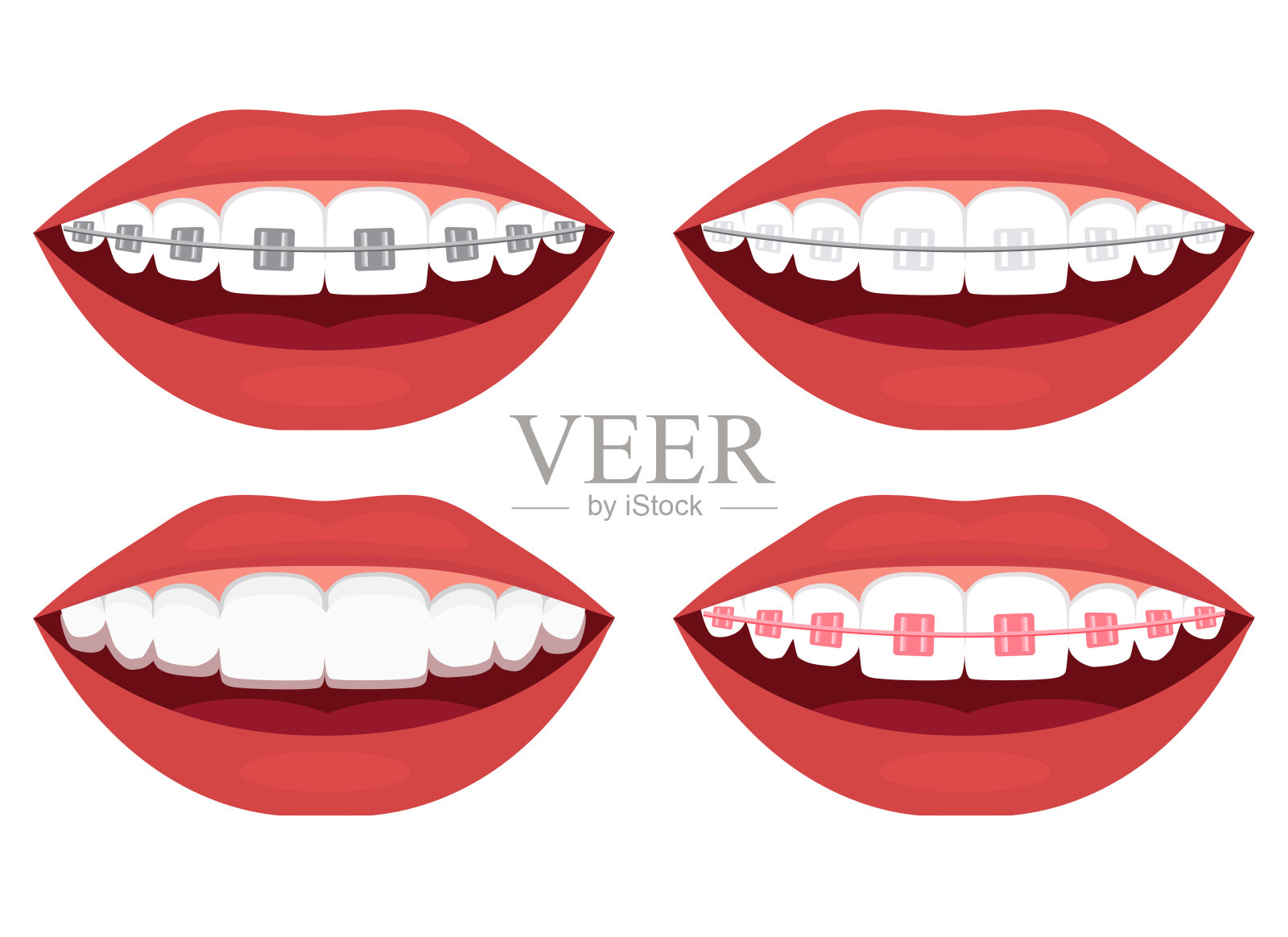 牙齿对齐。金属,陶瓷,塑料,绳索和隐形支架插画图片素材