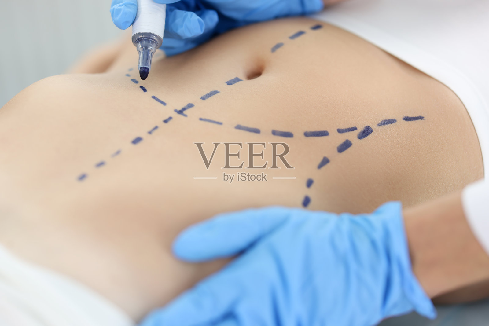 整形外科医生在病人腹部特写皮肤上画术前标记照片摄影图片