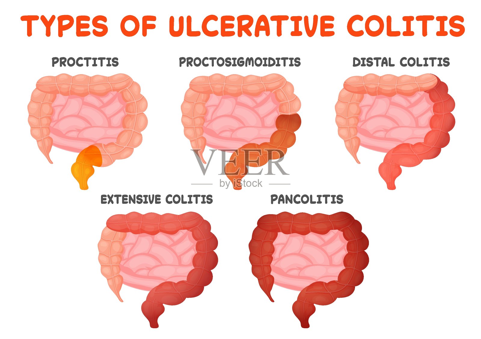溃疡性结肠炎类型,肠道疾病,从直肠炎到全肠炎的肠道炎症。医疗矢量图插画图片素材