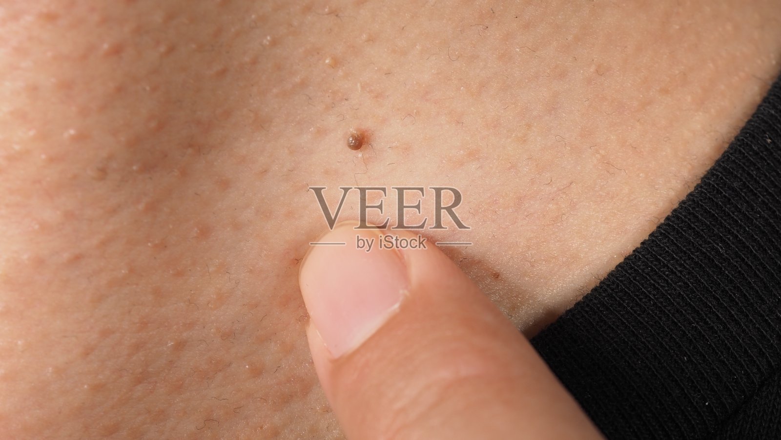 疣的脸。放大疣近眼睛。眼、鼻、颈周围皮肤乳头状瘤。皮肤上的胎记、乳头或痣的特写。小困难。皮肤上的良性生长。由病毒引起的。护肤品。照片摄影图片