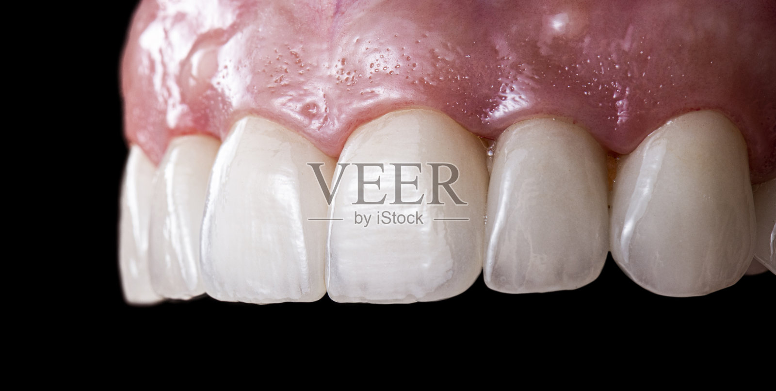 陶瓷冠饰面b3色照片摄影图片