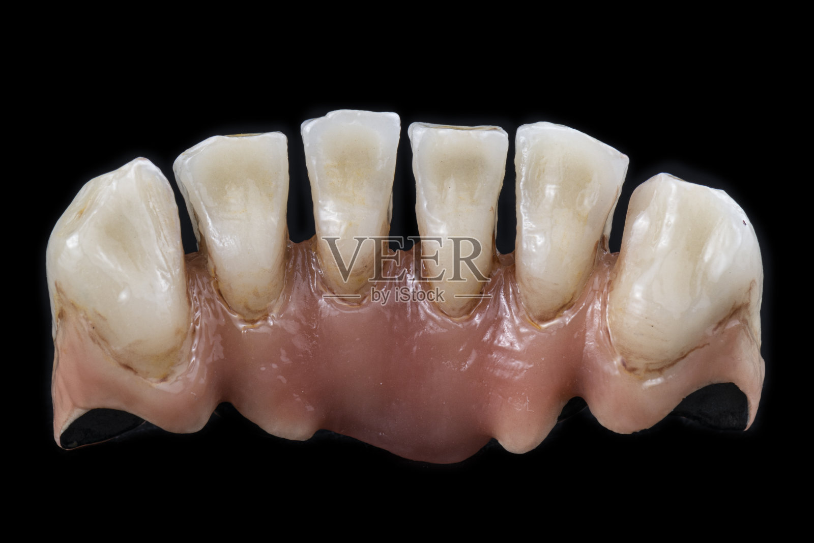 植入物上超天然金属陶瓷桥照片摄影图片