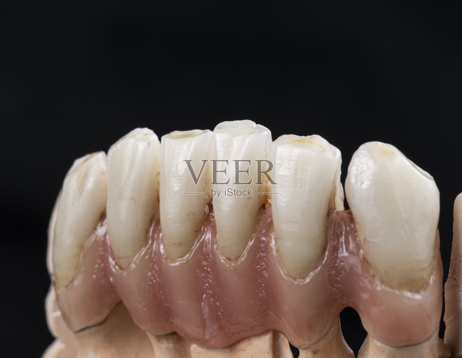 植入物上超天然金属陶瓷桥照片摄影图片