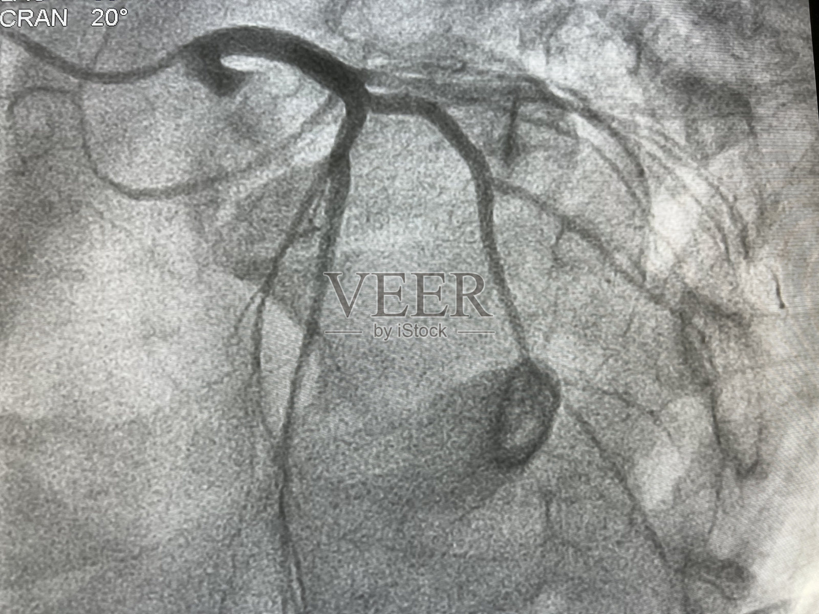 冠状动脉造影照片摄影图片