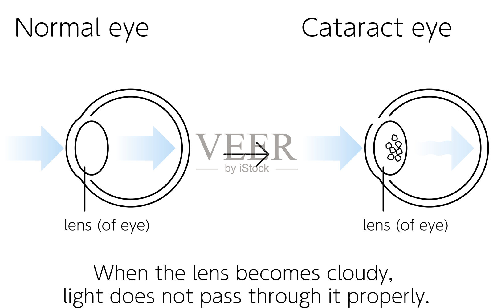 正常及白内障眼,图示(划线)插画图片素材
