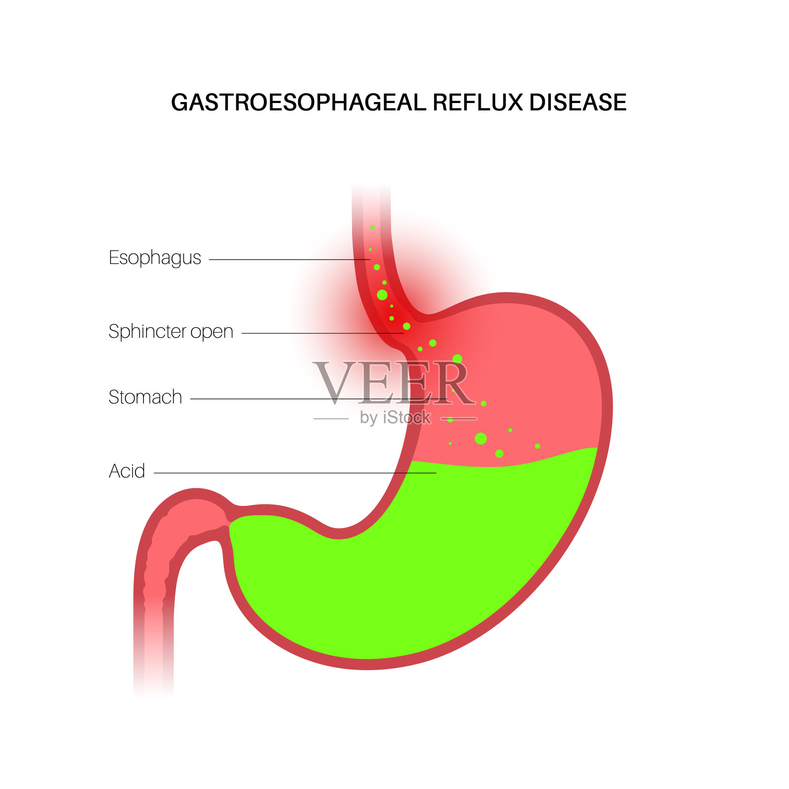 胃食管返流疾病插画图片素材