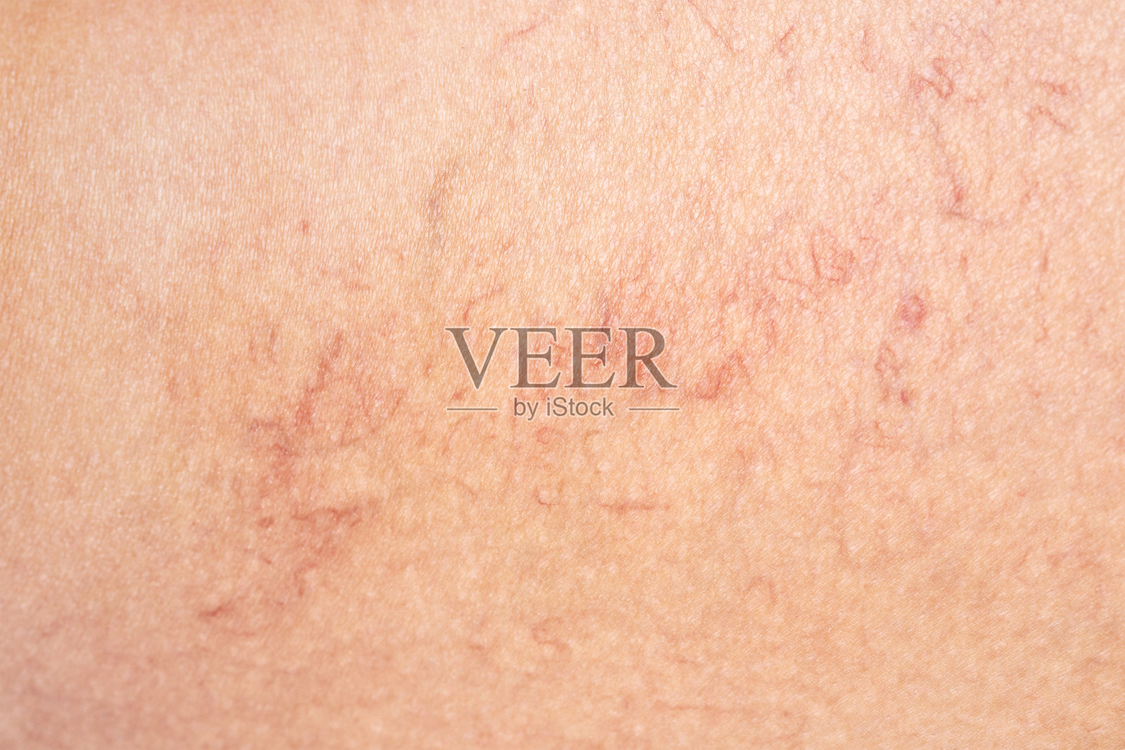 去除腿部的静脉曲张。毛细血管扩张症的医学检查和治疗。Phlebeurysm。照片摄影图片