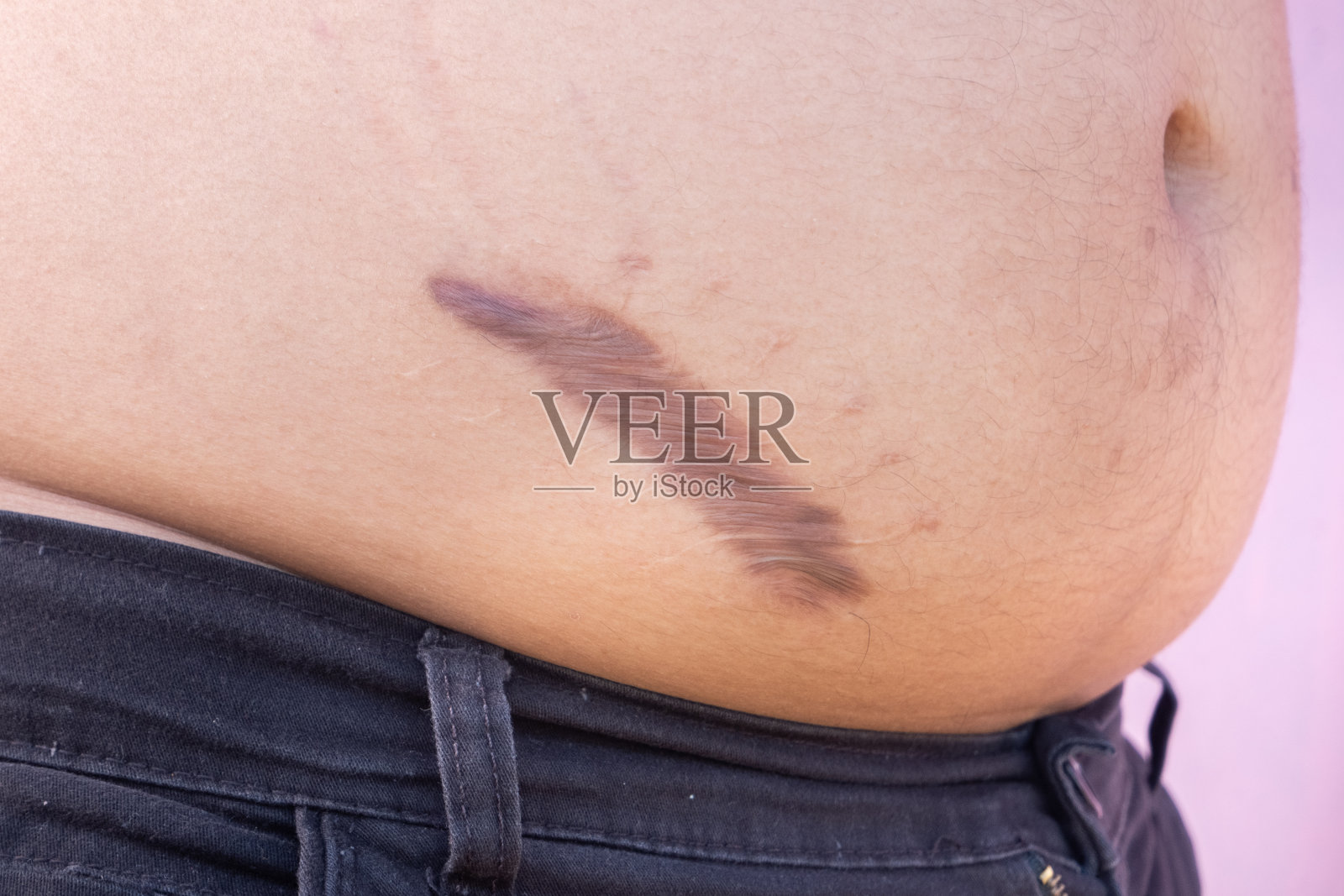 阑尾切除术后胃瘢痕疙瘩照片摄影图片