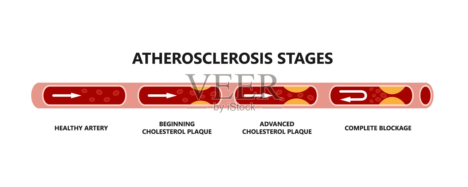 动脉粥样硬化阶段。健康的动脉,开始胆固醇斑块,晚期胆固醇斑块,完全堵塞。插画图片素材