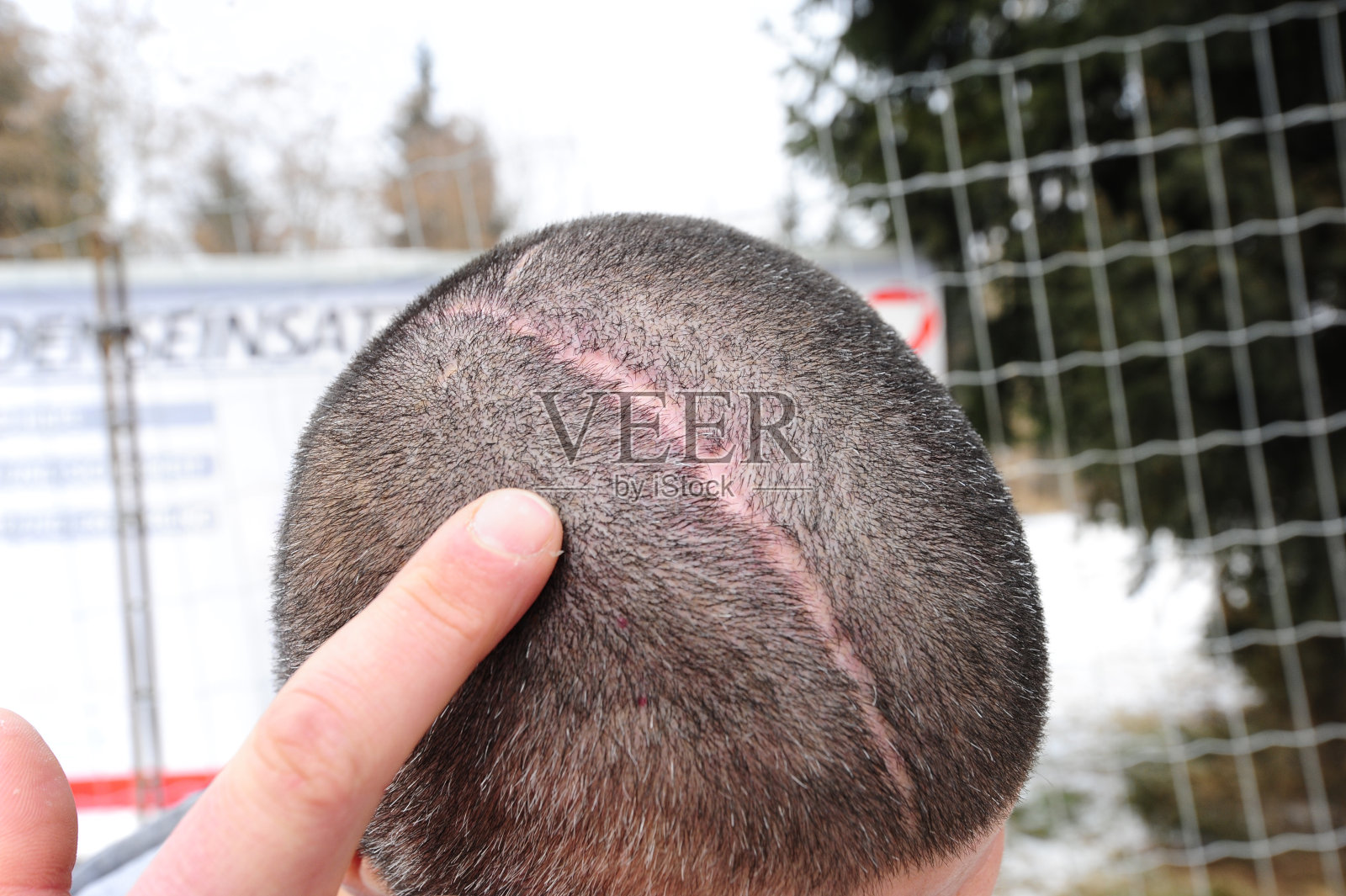 事故后头部受伤照片摄影图片