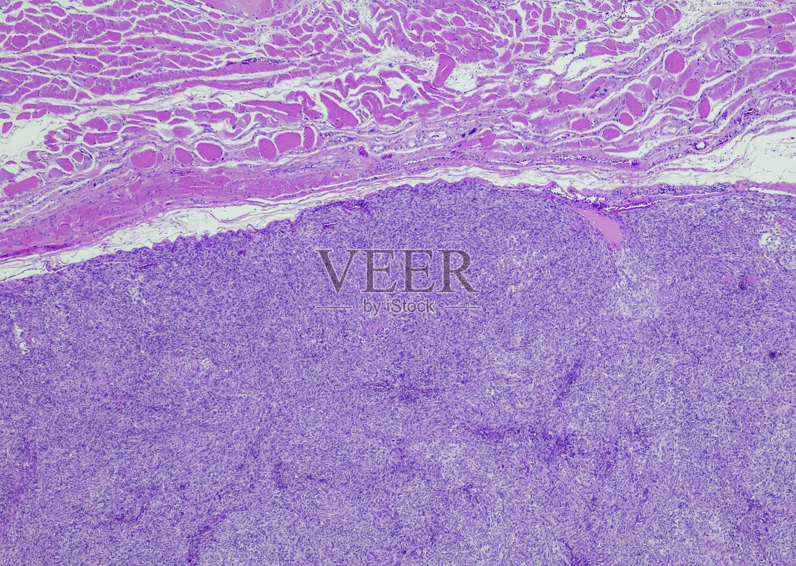 孤独的纤维性肿瘤照片摄影图片