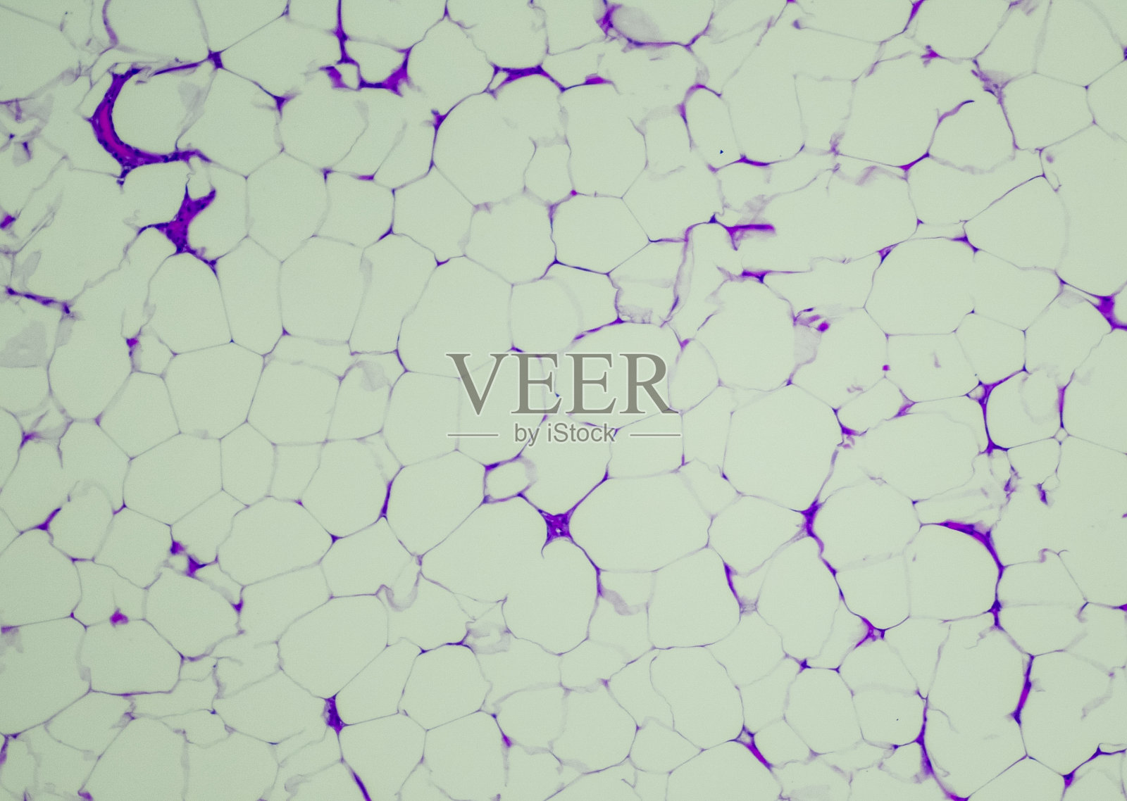 脂肪瘤照片摄影图片