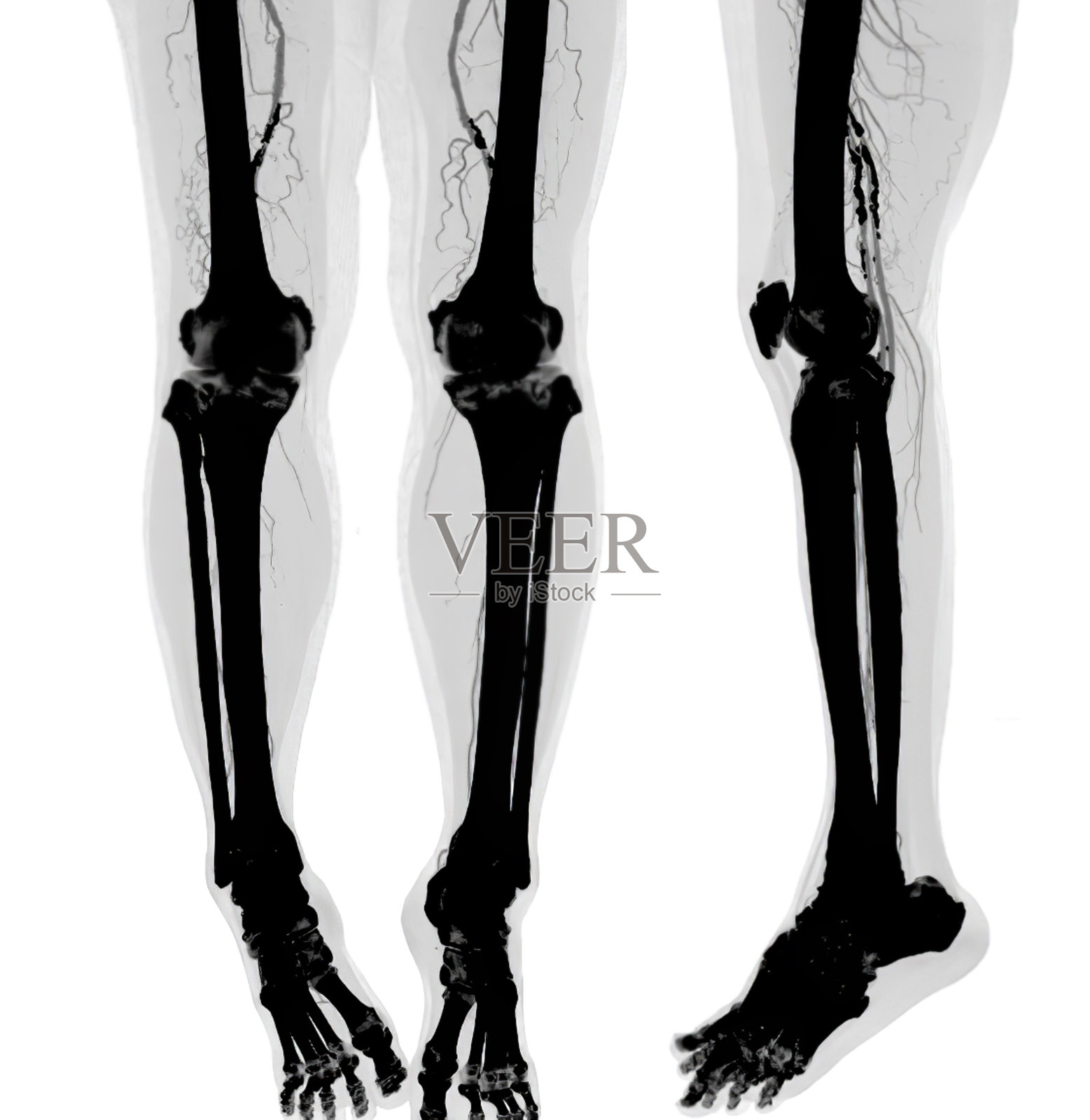 CTA股动脉脱落。照片摄影图片