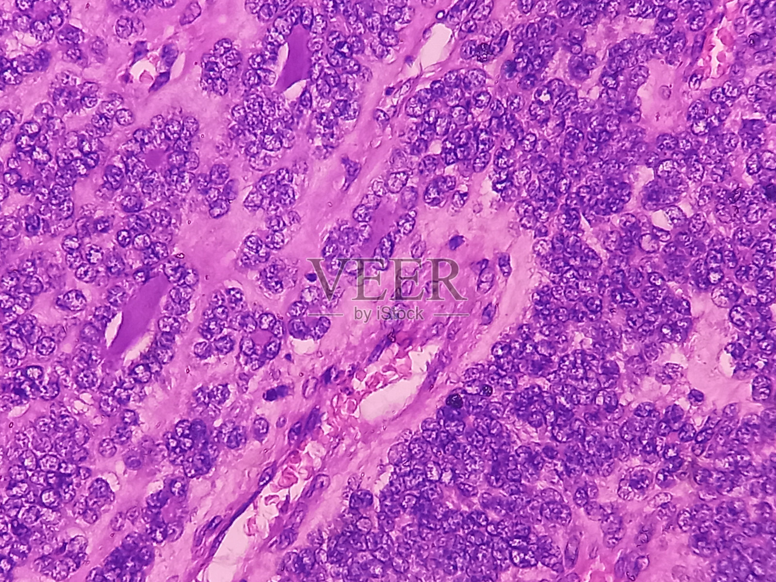 甲状腺癌:滤泡型乳头状癌的显微镜图像。显示不典型甲状腺滤泡上皮细胞恶性肿瘤。照片摄影图片