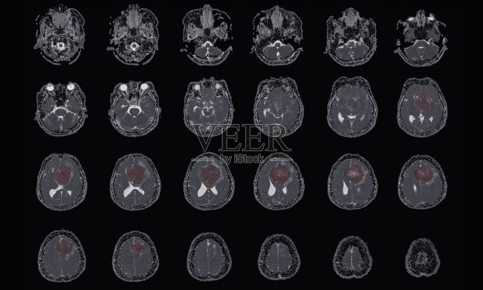 MRI颅脑:脑膜瘤起源于大脑镰前部,延伸至双侧额叶区域,左侧额叶邻近微小的病灶周围水肿,医学图像概念。照片摄影图片
