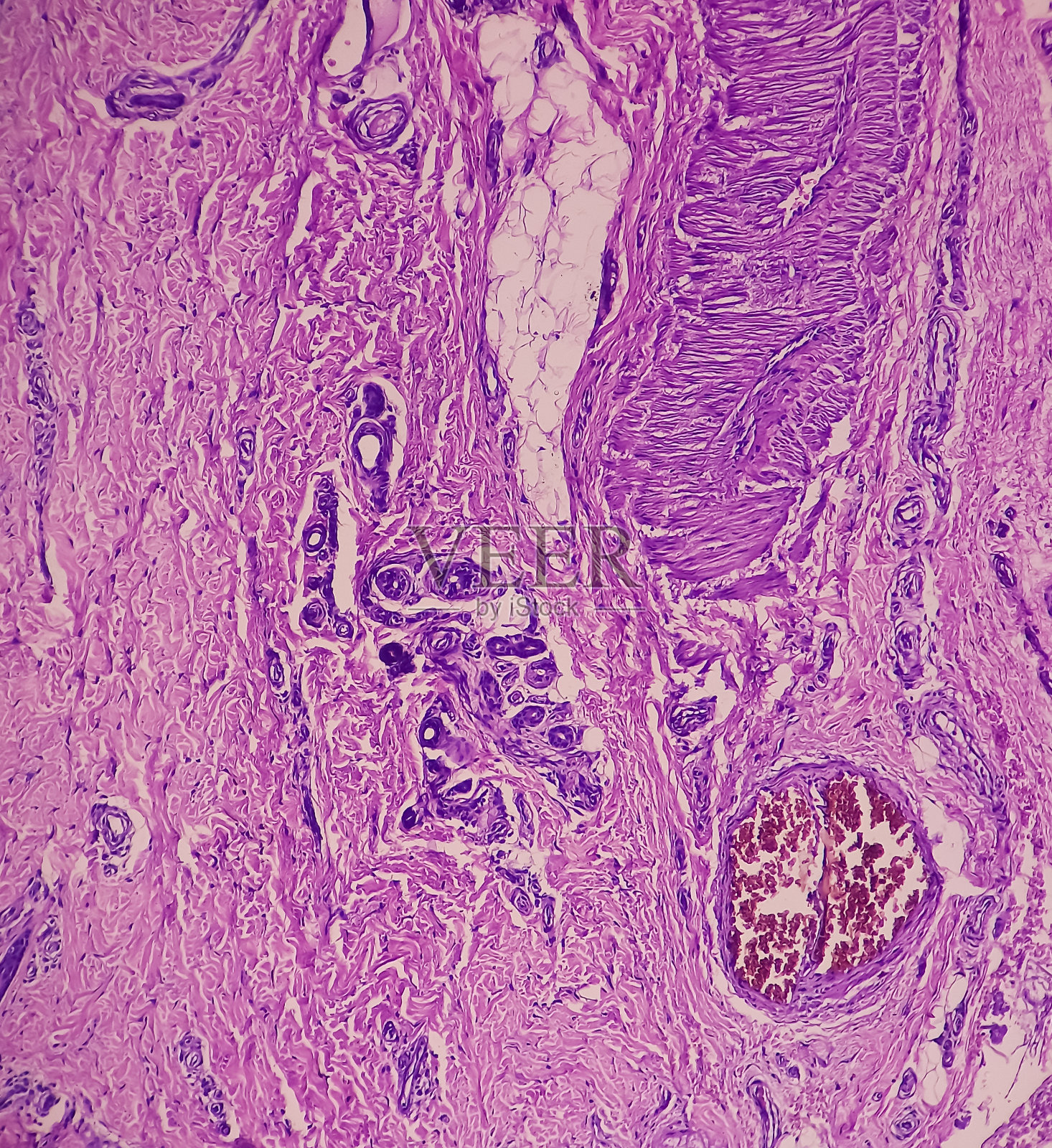 手指活检,指癌,浸润性鳞状细胞癌,ii级。显示不典型鳞状上皮细胞恶性肿瘤。照片摄影图片