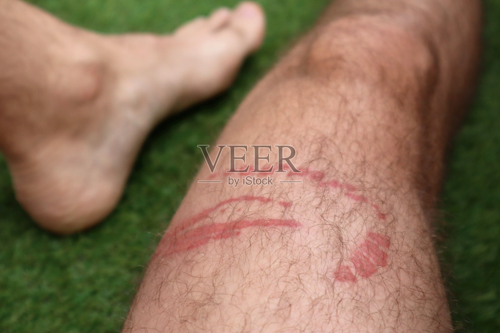 一个男人的腿上被水母蛰伤了照片摄影图片