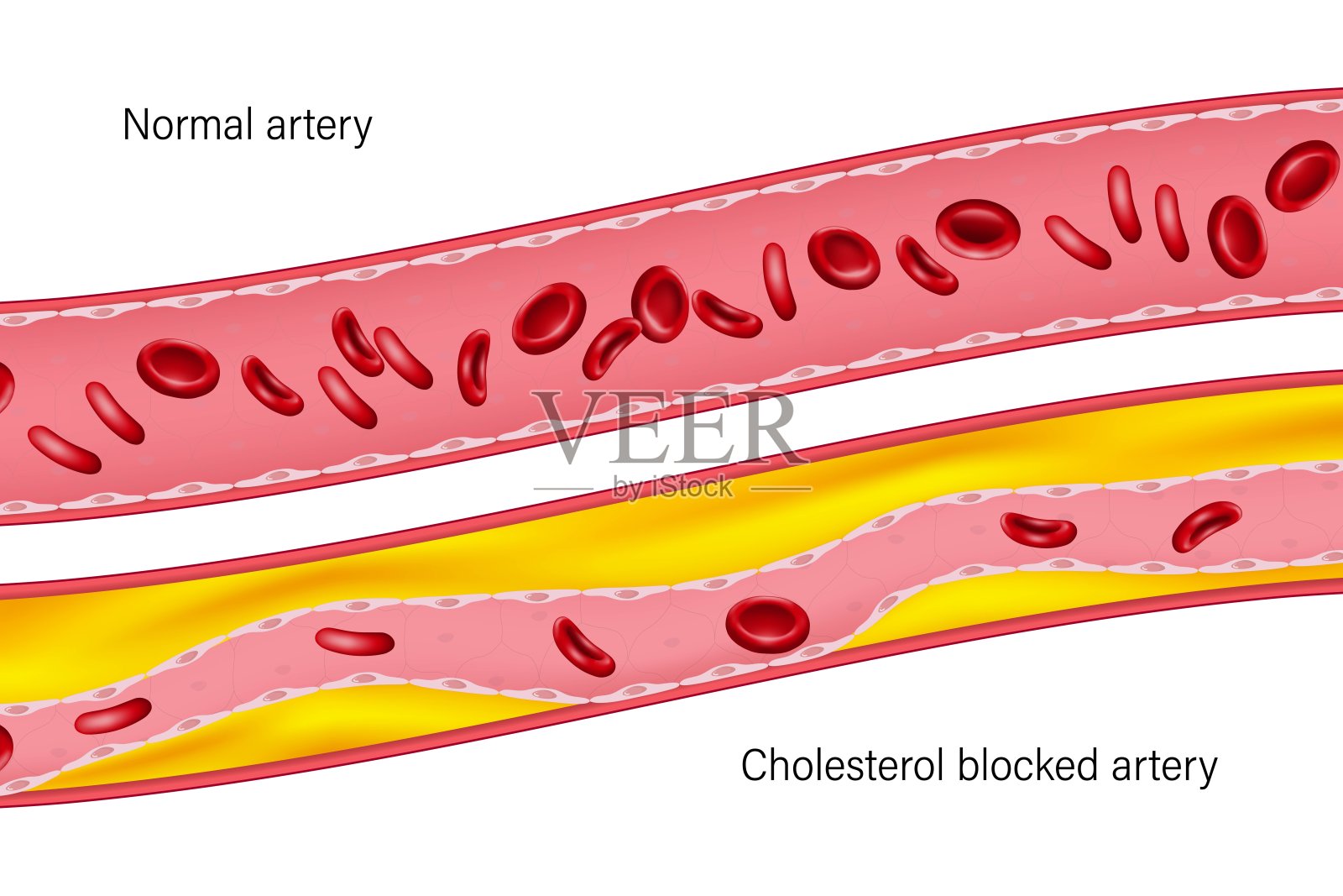 正常动脉和胆固醇阻塞动脉。由胆固醇引起的动脉阻塞。血管中的胆固醇。插画图片素材