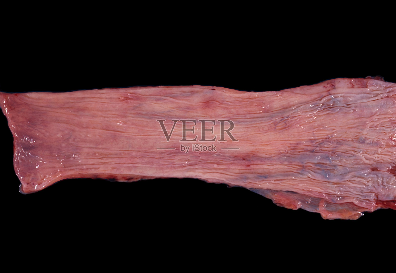 人类食管静脉曲张照片摄影图片