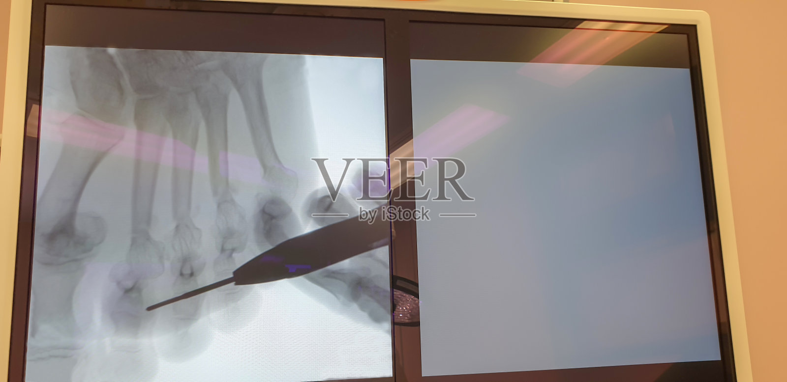 医用x光屏显示手术中的脚和脚趾照片摄影图片