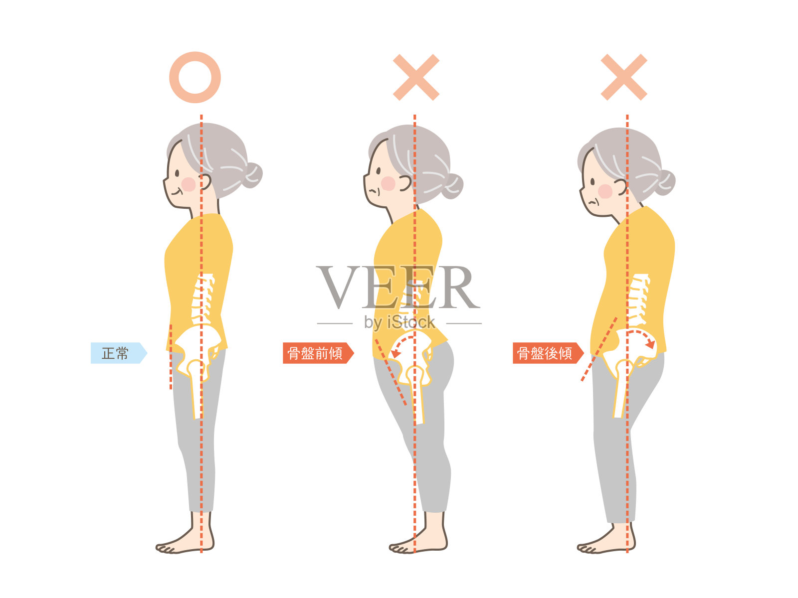 一位老年女性的好姿势和坏姿势样本——骨盆插画图片素材
