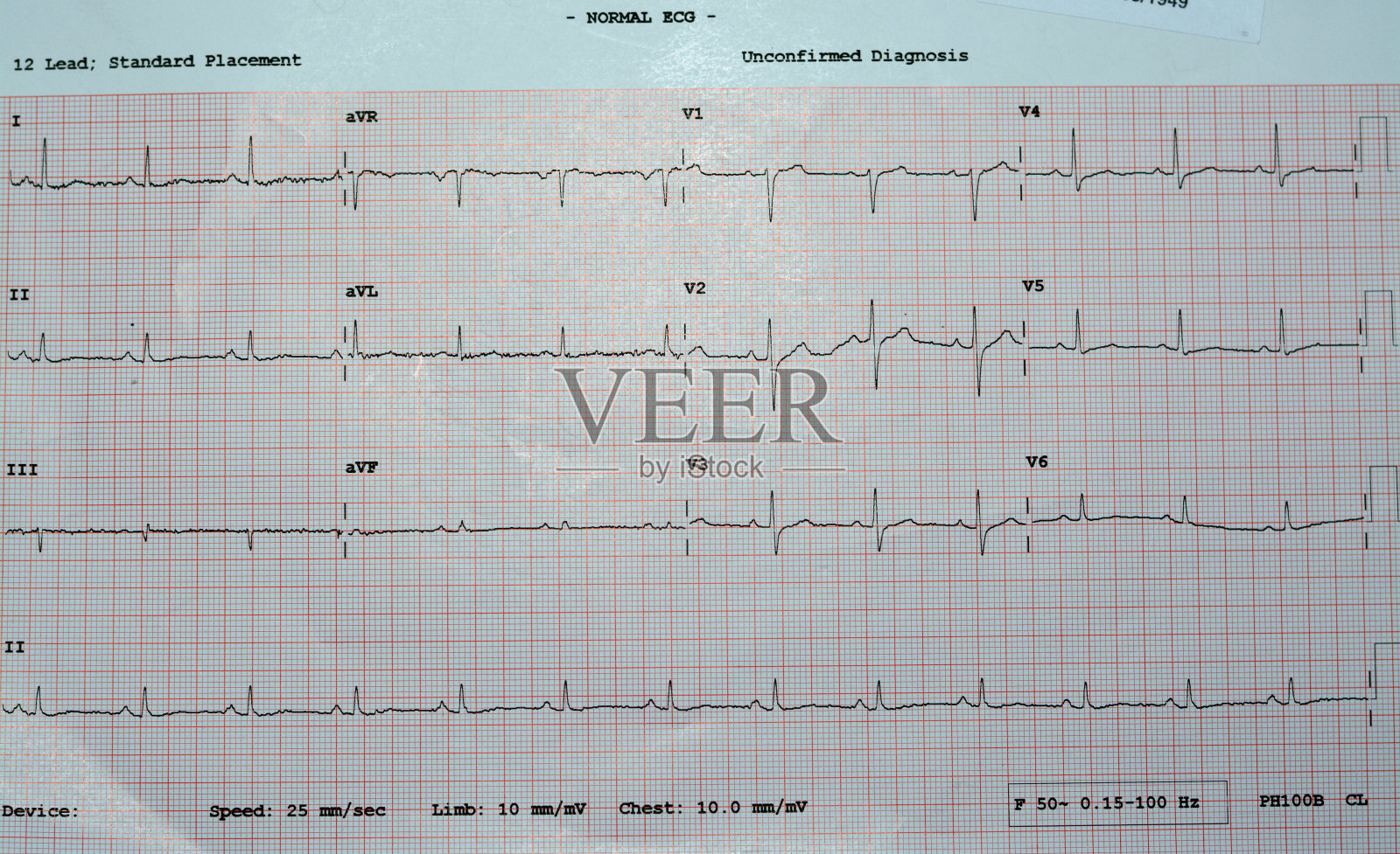 心电图,描绘心脏的电流,提供关于心脏状况和节律的信息,排除心绞痛或心肌梗塞,正常心电图照片摄影图片