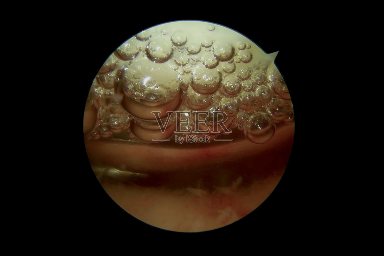 关节镜手术时,膝关节内有气泡照片摄影图片