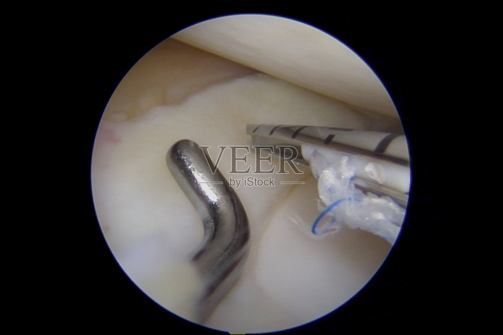 膝关节半月板全内修复的关节镜视图照片摄影图片