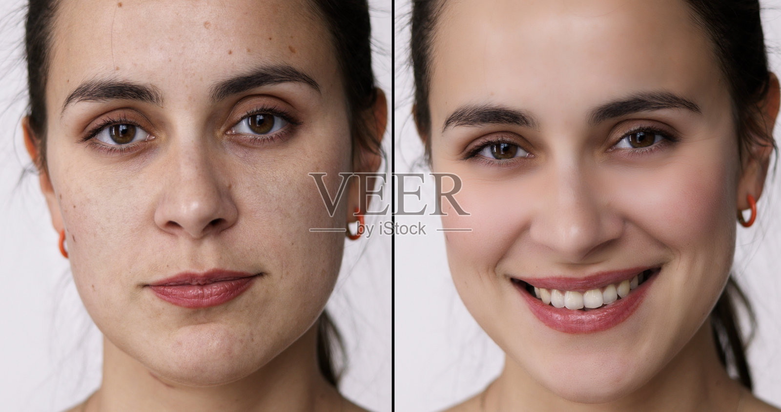 年龄抗额头皱纹治疗之前照片摄影图片