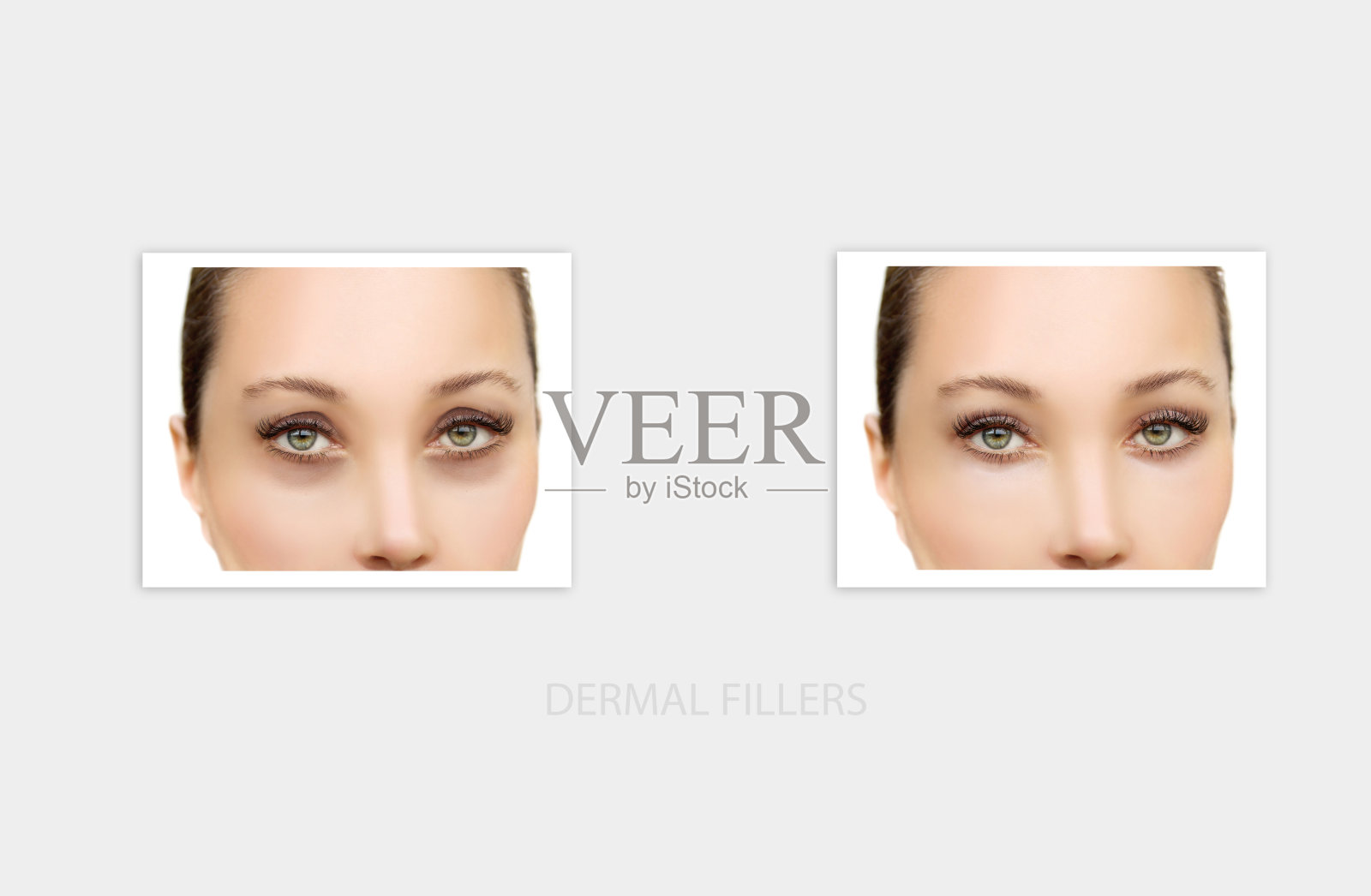 撕裂槽填料,a型架畸形。脂肪移植或真皮填充治疗。特定部位注射玻尿酸。照片摄影图片