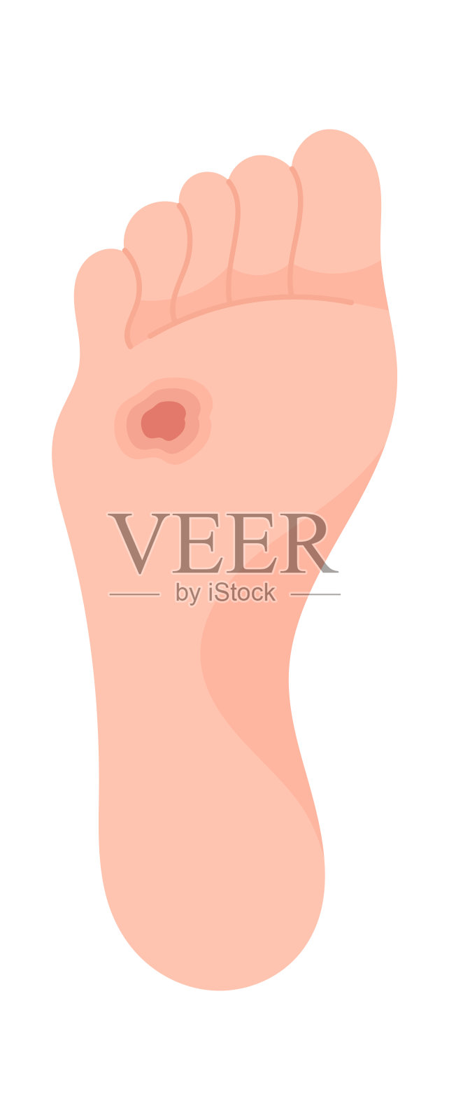 深溃疡足病插画图片素材