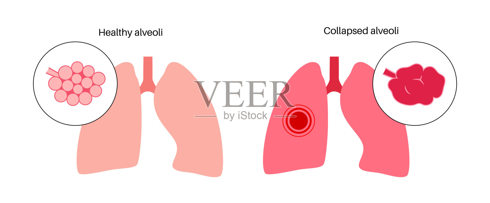 肺气肿解剖海报插画图片素材