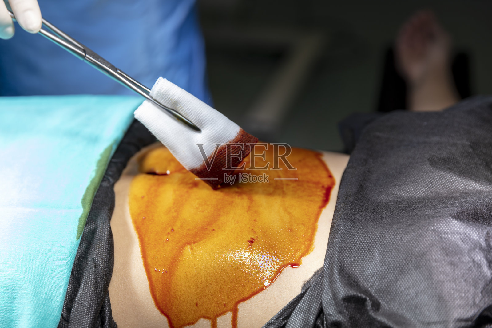 手术前对皮肤消毒照片摄影图片