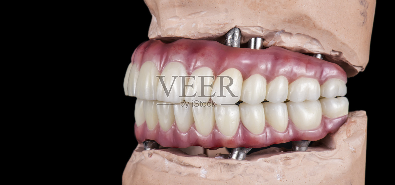 Emax陶瓷在混合种植体桥上的应用照片摄影图片