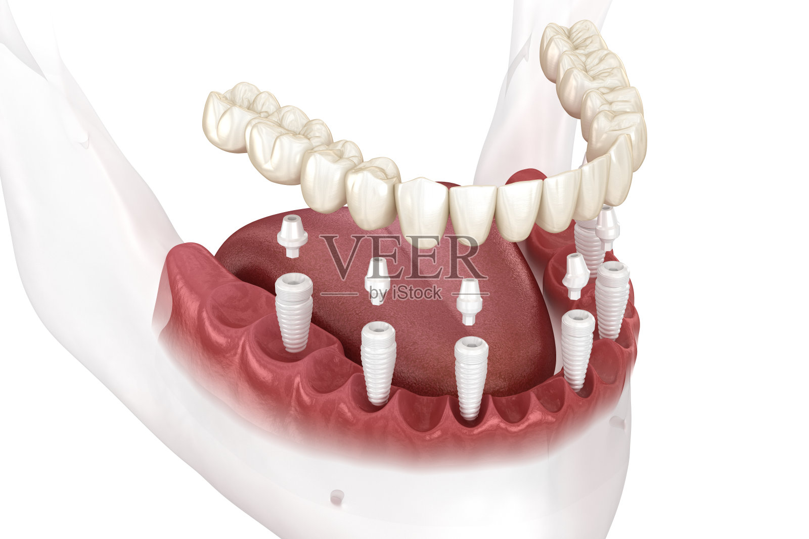 可拆卸的下颌假体全部由陶瓷植入物支持的6个系统。牙齿三维演示照片摄影图片