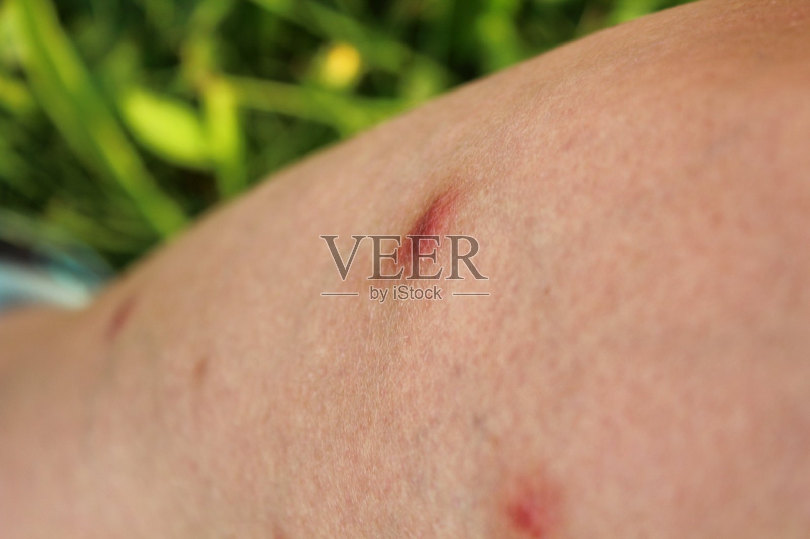 一个女人的腿被蚊子叮得发炎。她在度假时被咬伤了。照片摄影图片