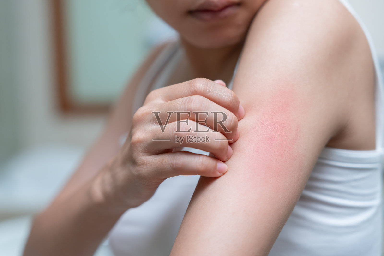 皮肤问题与美容。年轻女性抓挠身体有皮肤过敏引起的皮肤瘙痒、类固醇过敏、敏感皮肤、晒伤引起的皮肤发红、化学过敏、皮疹、昆虫叮咬、脂溢性皮炎。照片摄影图片