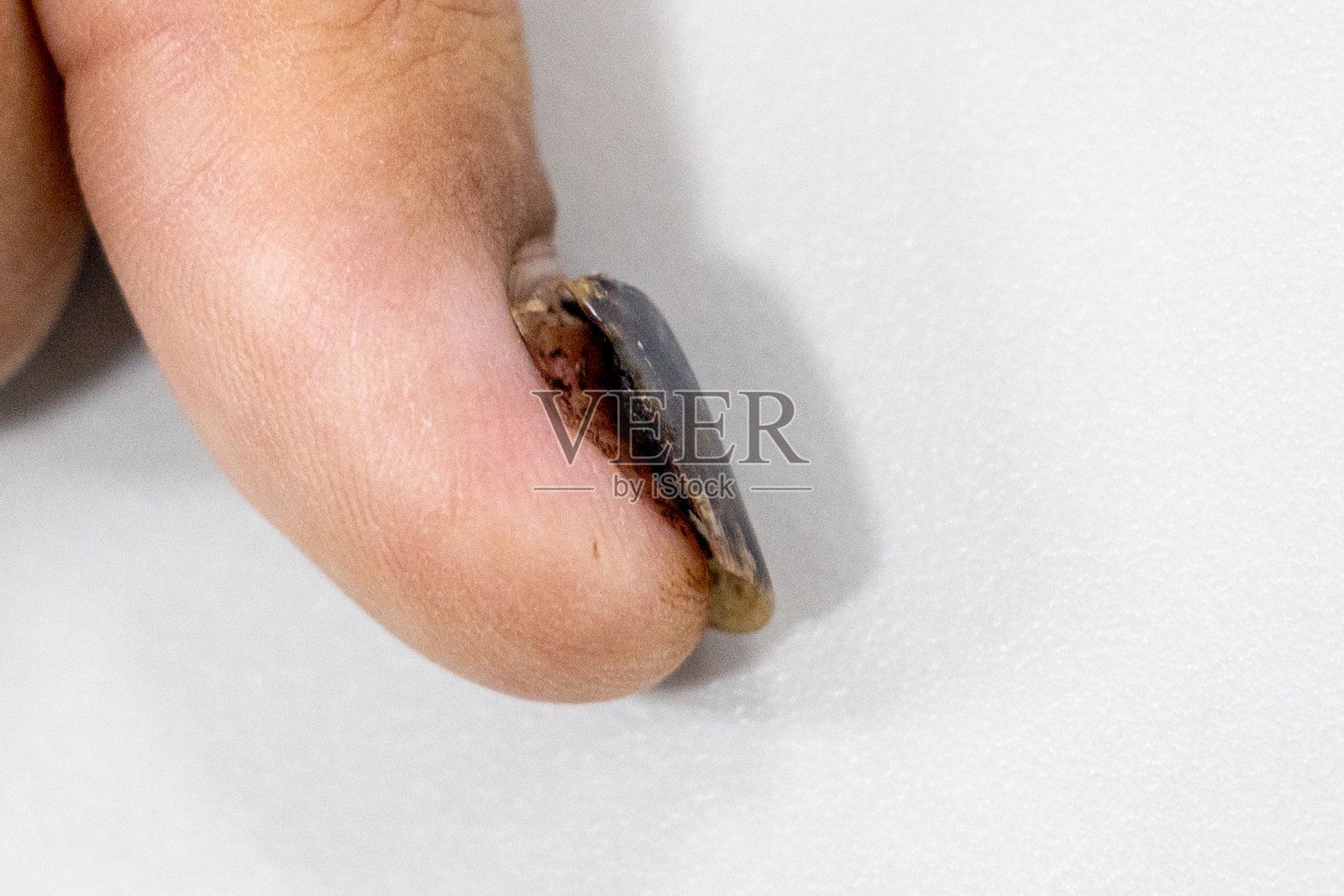 手指受伤,指甲撕裂,擦伤,指甲会脱落。照片摄影图片