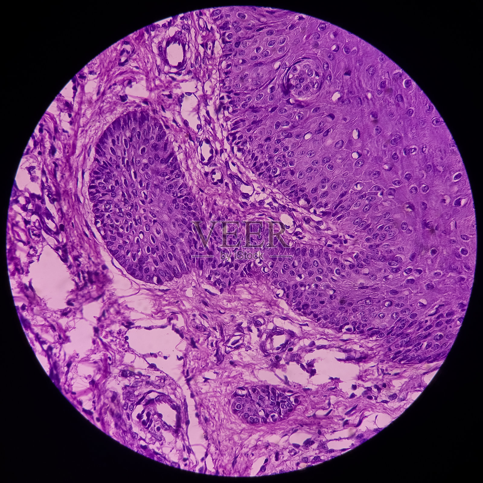 疣体或颏部皮肤疣,镜下可见表皮增生伴角化过度和乳头状瘤。照片摄影图片